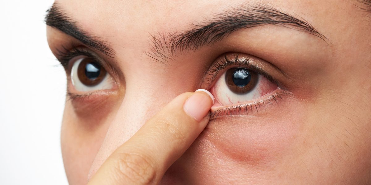 What is dry eye and what are some common causes?